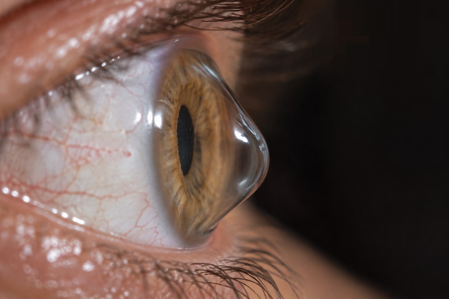 Perfil corneal con forma cónica característica del queratocono