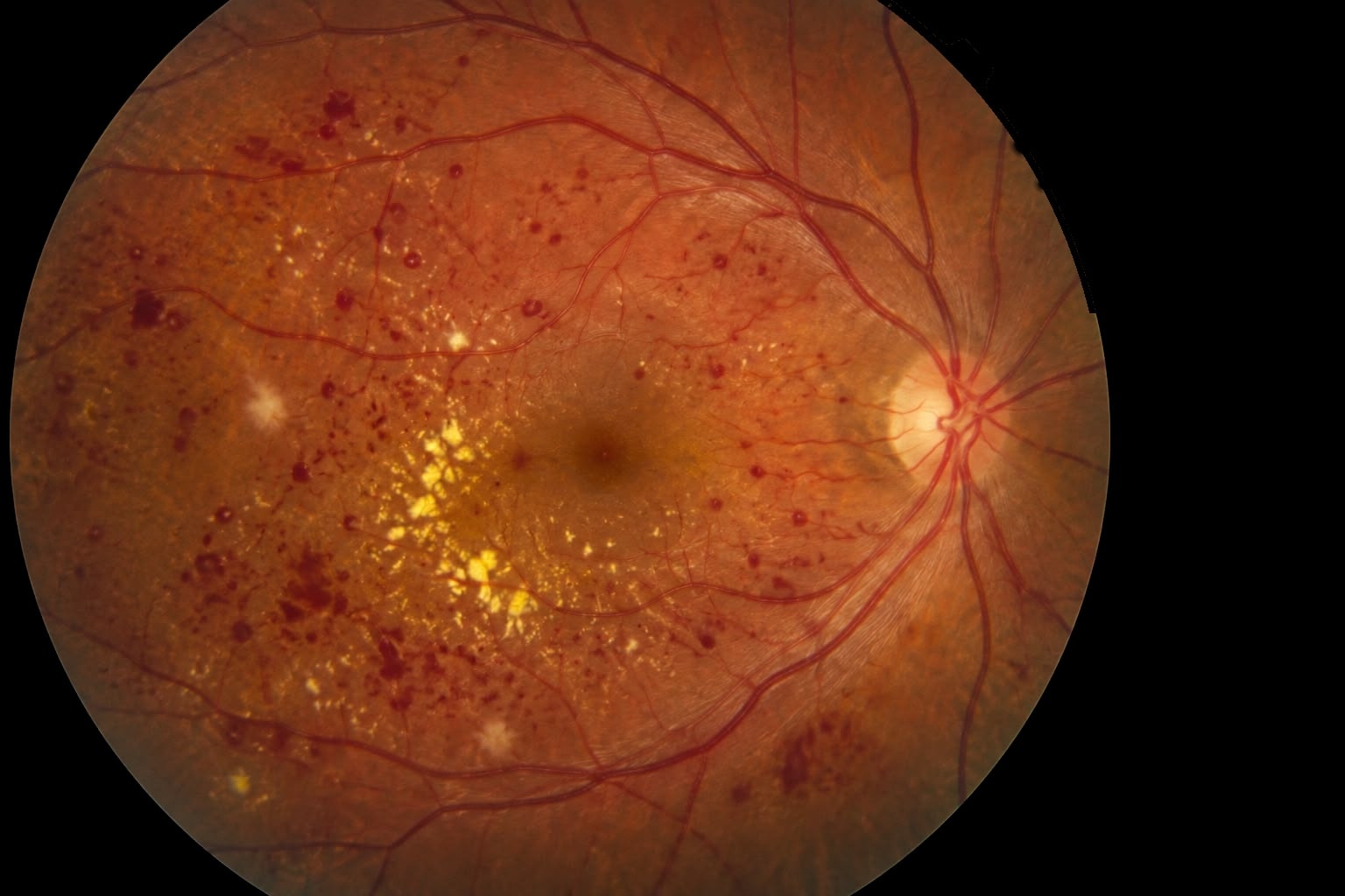 Fondo de ojo con signos de retinopatía diabética